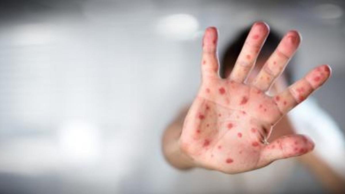 O fetiță de doar un an și jumătate a murit la Bacău din cauza rujeolei